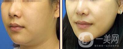 等離子激光溶脂價格、大概需要多少錢