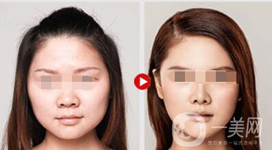 等離子激光溶脂價格、大概需要多少錢