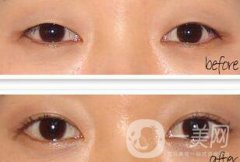 韓式開眼角多少錢 韓式*開眼角價格詳解
