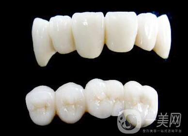 烤瓷牙能用多長(zhǎng)時(shí)間？烤瓷牙的壽命有多長(zhǎng)