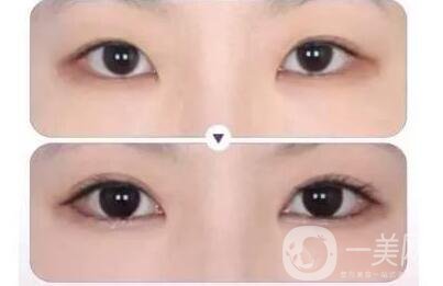 割雙眼皮,風(fēng)險(xiǎn)