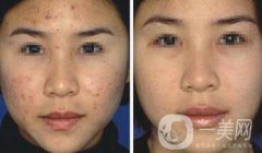像素激光去痘多久才會(huì)好 祛痘對(duì)果