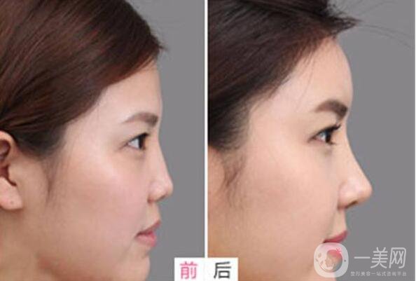 *,術后注意事項