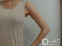 廣東手臂吸脂需要多少錢 廣東手臂吸脂價格介紹