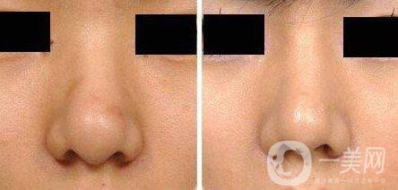 北京,鼻翼縮小,多少錢