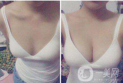 妙桃假體豐胸,多少錢(qián)