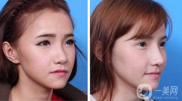 北京,耳軟骨墊鼻尖,價(jià)格