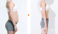 上海360度吸脂多少錢(qián) 360度吸脂價(jià)格詳解