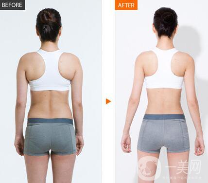 上海360度吸脂多少錢(qián) 360度吸脂價(jià)格詳解