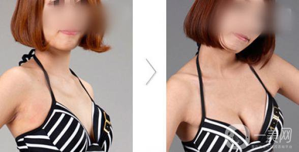 豐胸手術(shù)后注意什么 注意事項(xiàng)一覽