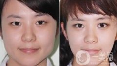 注射瘦臉*多少錢(qián) 注射瘦臉*價(jià)格詳解