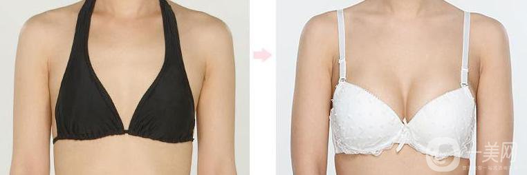 假體隆胸多久可以抽煙 注意事項(xiàng)