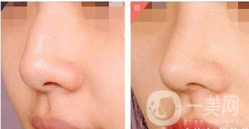 駝峰鼻矯正多久能恢復(fù) 要注意什么