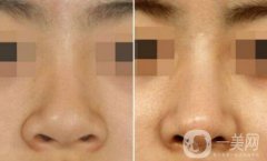 深圳鼻翼縮小多少錢(qián)能做 鼻翼縮小手術(shù)價(jià)格詳解
