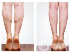 注射瘦臉瘦小腿價(jià)格 費(fèi)用是多少？