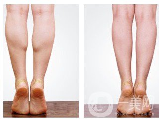 *瘦小腿價格 費用是多少？