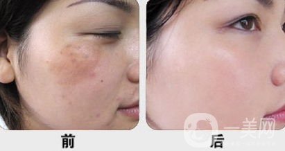黃褐斑怎么形成的 怎么去除？