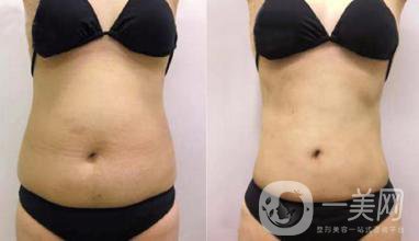 腰腹吸脂后怎樣保持 注意有哪些