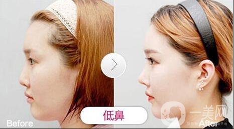 *術(shù)后1-7天的反應(yīng) *術(shù)后怎么護(hù)理