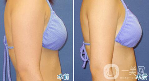 北京手臂吸脂價位是多少 手臂吸脂貴嗎