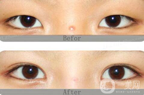 杭州哪里割雙眼皮好 杭州哪家雙眼皮醫(yī)院好