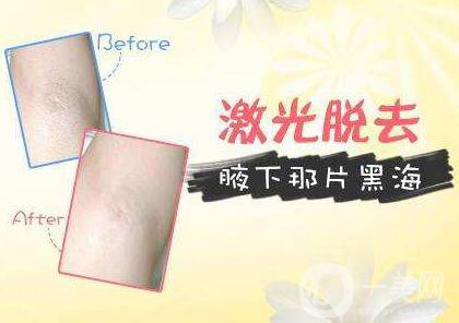 激光脫腋毛,價(jià)格