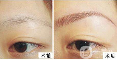 上海,假體豐眉弓,價(jià)格