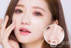 北京自體脂肪隆鼻多少錢 北京自體脂肪隆鼻價(jià)格介紹