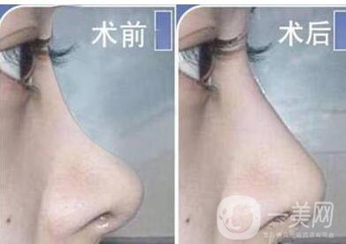 北京,自體脂肪隆鼻,多少錢(qián)