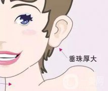 注射玻尿酸豐耳垂果怎么樣？