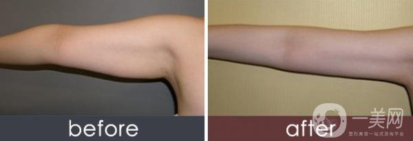 上臂吸脂多久看到*果 適用于哪些人群？