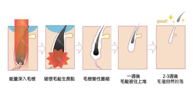 做一次激光脫毛的價格大概要多少錢？