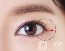 做完開眼角手術(shù)之后果明X嗎？