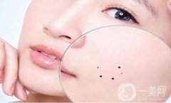 去痣多少錢 祛痣價位詳情一覽