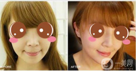 膨體聚四氟乙烯隆鼻*果怎么樣？