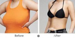 巨乳縮小術(shù)疤痕大嗎 巨乳縮小會留疤嗎