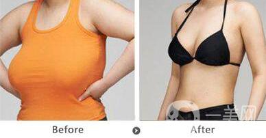 巨乳縮小術(shù)疤痕大嗎 巨乳縮小會(huì)留疤嗎