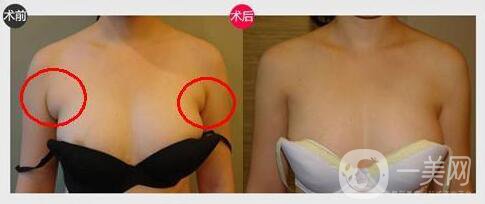 上海副乳切割手術(shù)多少錢 副乳切除手術(shù)價(jià)格詳解