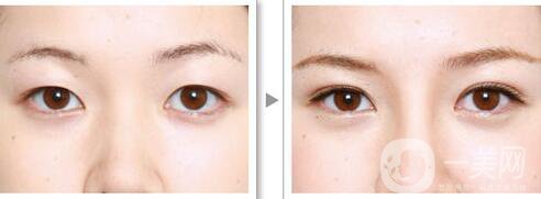 成都割雙眼皮價格是多少 做雙眼皮手術(shù)大概多少錢