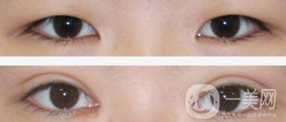 成都割雙眼皮價格是多少 做雙眼皮手術(shù)大概多少錢