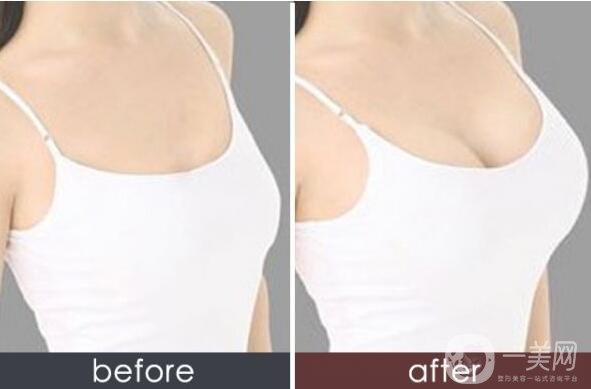 妙桃假體隆胸,價(jià)格