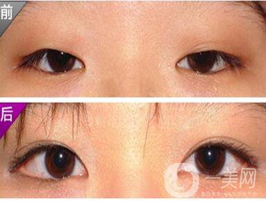 開(kāi)眼角,多少錢