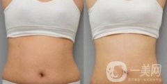 腰腹吸脂后多久變細(xì) 腰腹吸脂幾天恢復(fù)