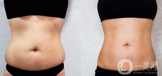 腰腹吸脂后多久變細(xì) 腰腹吸脂幾天恢復(fù)