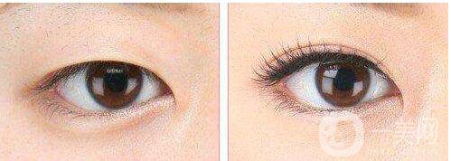 割雙眼皮,怎么樣,*果