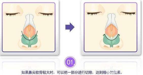 鼻頭縮小*果 鼻頭縮小術后*果