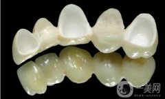 美容冠多少錢 價(jià)格介紹一覽