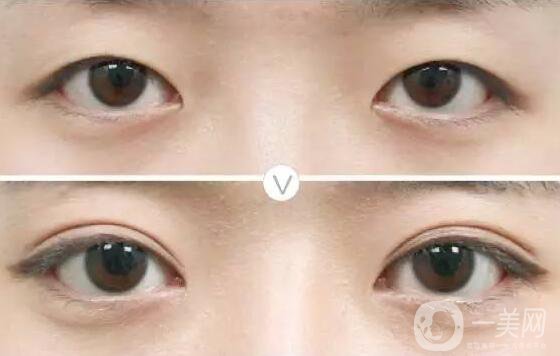 雙眼皮做失敗怎么修復(fù) 雙眼皮失敗修復(fù)