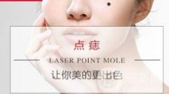 激光點痦子多少錢 激光點痣價格介紹