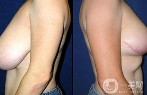 乳房下垂矯正方法介紹 乳房下垂矯正手術(shù)多少錢